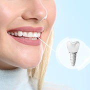 A picture highlighting a woman’s dental implant