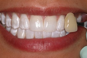 Smile compared with original dental discoloration after teeth whitening