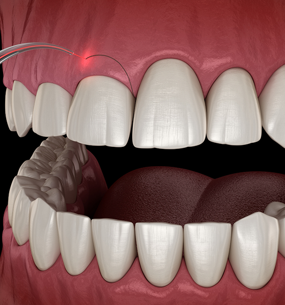 Illustrated dental laser treating an uneven gumline