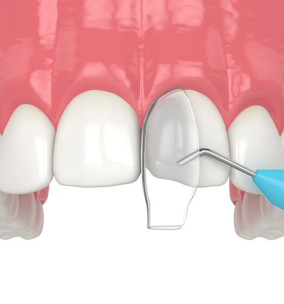 Illustration of dental bonding material being placed on a chipped tooth