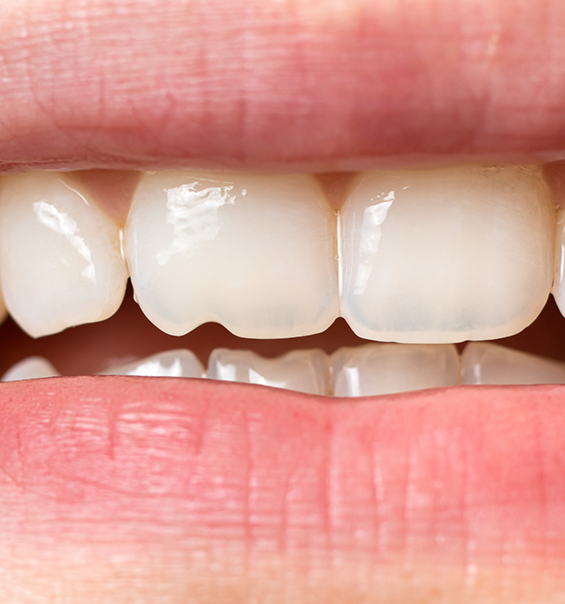 Close up of a smile with a chipped front tooth