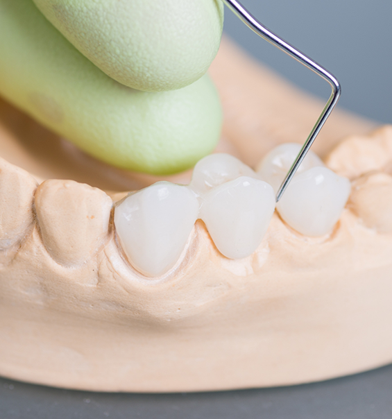 Dental bridge replacing three teeth in a model of the mouth