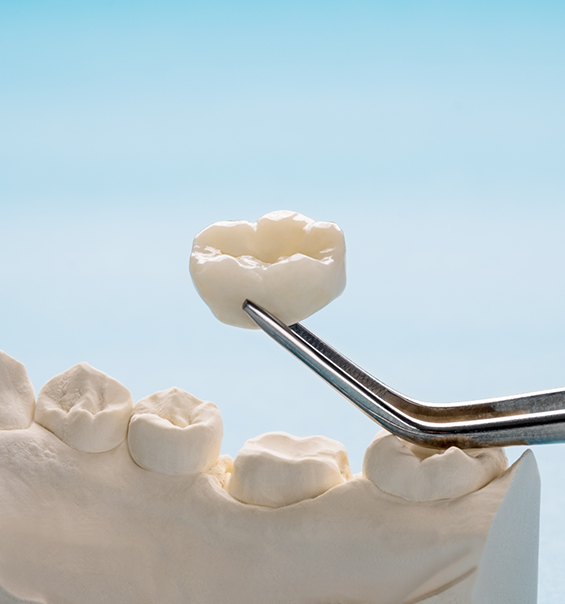 Tweezers holding a dental crown next to a model of the mouth