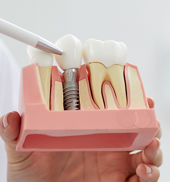 Dentist gesturing to a model of a dental implant in West Palm Beach