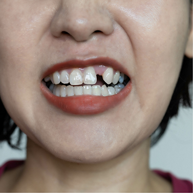 Person smiling with one missing upper tooth