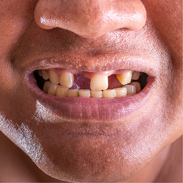 Close up of person smiling with several missing teeth