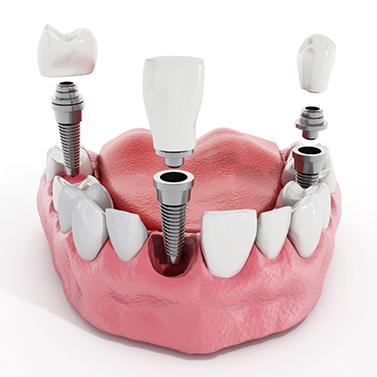 Illustration of three dental crowns being fitted onto three dental implants