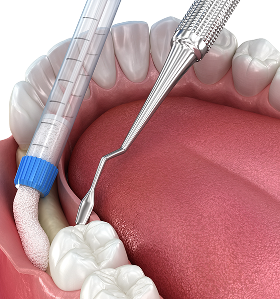 Illustration of bone grafting material being placed into jawbone