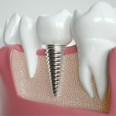 Illustrated dental implant post in the lower jawbone