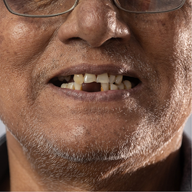 Close up of man smiling with a few missing teeth