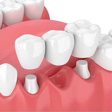 Illustrated dental bridge replacing a missing tooth