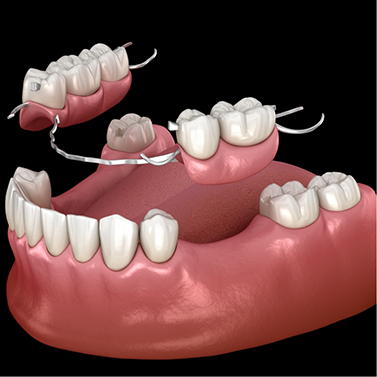 Illustrated partial denture replacing a few missing teeth along an arch