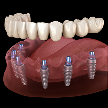 Illustration of a full denture being secured onto six dental implants