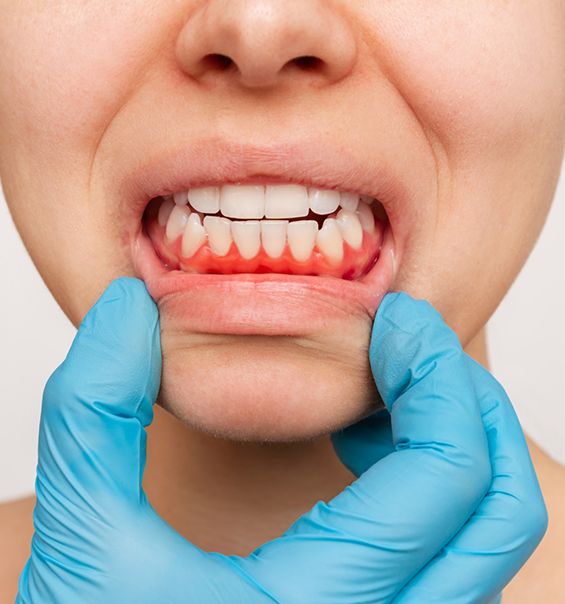 Close up of person with redness in their gums