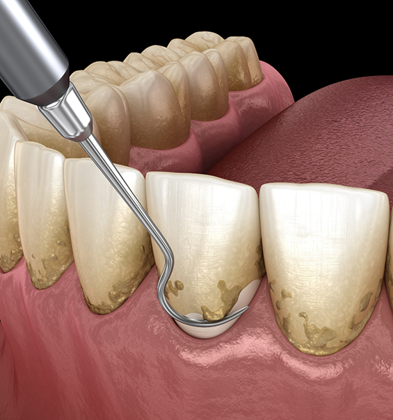 Illustration of a dental scaler clearing plaque buildup from the teeth and gumline