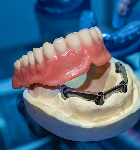 Model of an implant denture on a table