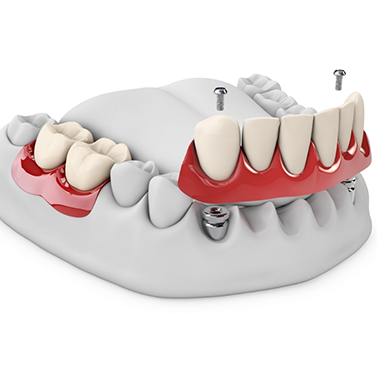 Illustration of a denture being fixed onto dental implants