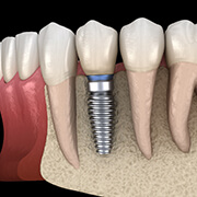 dental implant in the lower jaw
