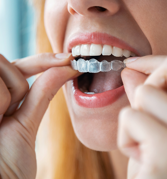 Close up of a woman placing a clear aligner over her teeth