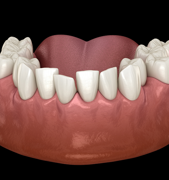 Illustration of a lower arch of crooked teeth