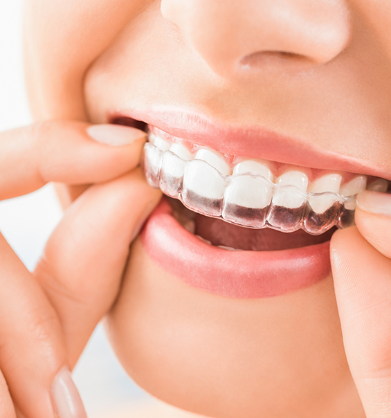 Person placing a clear aligner over their upper teeth