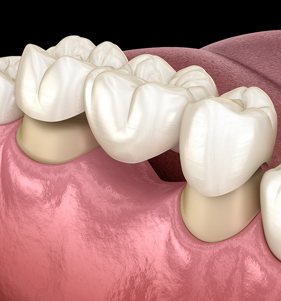 Illustration of a dental bridge being placed to replace a missing tooth