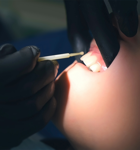 Close up of a dental patient having fluoride applied to their teeth