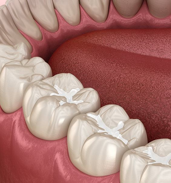 Illustrated row of teeth with dental sealants