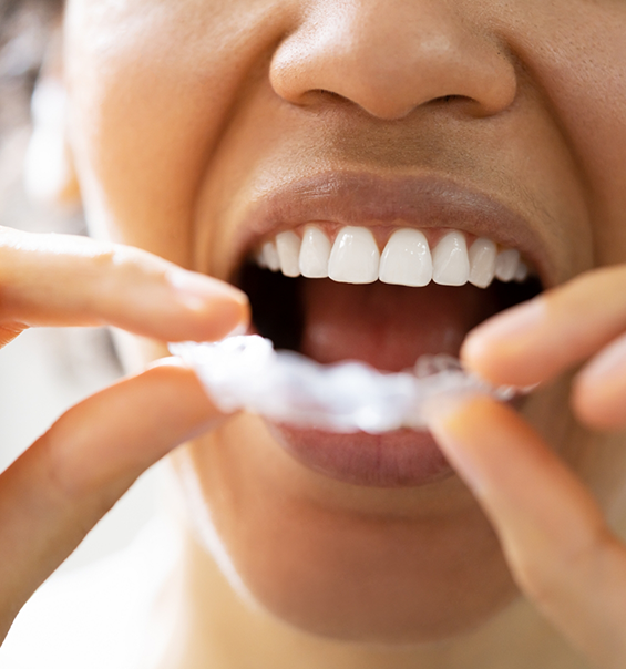 Person placing a clear nightguard tray over their teeth