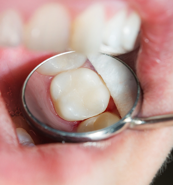 Close up of a dental mirror in the mouth reflecting a tooth