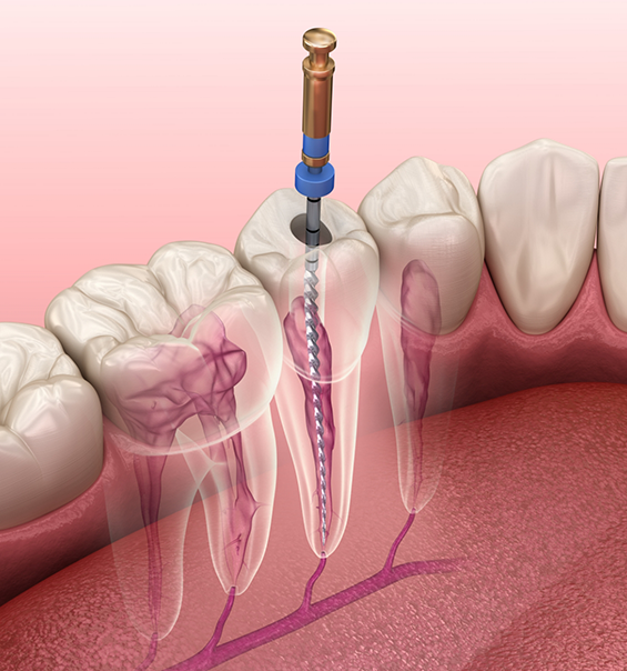 Illustrated dental instrument treating the inside of a tooth