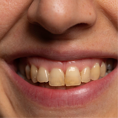 Close up of person smiling with discolored teeth