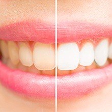 Closeup of teeth split before and after whitening
