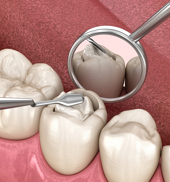 Illustration of a white filling being placed inside of a tooth