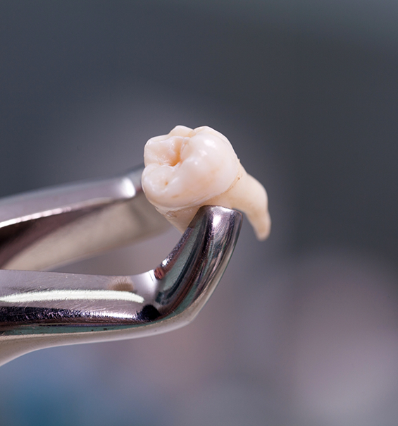 Clasp holding an extracted tooth