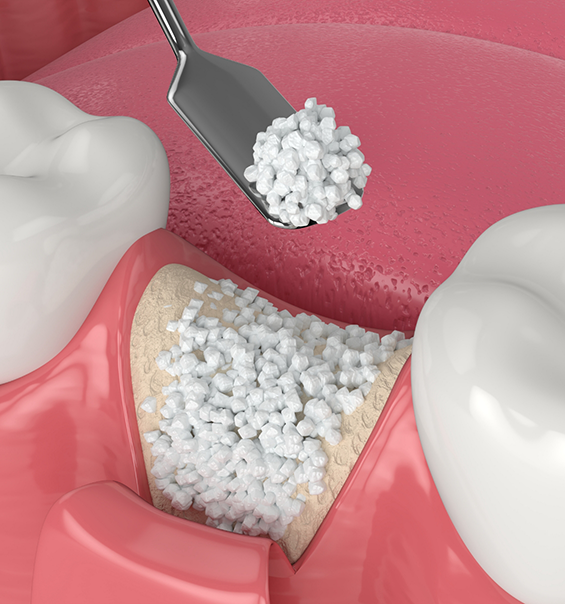 Illustration of bone grafting material being placed into jawbone after tooth extraction