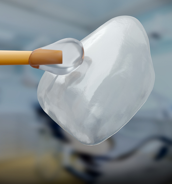 Close up of adhesive material being painted onto a dental veneer