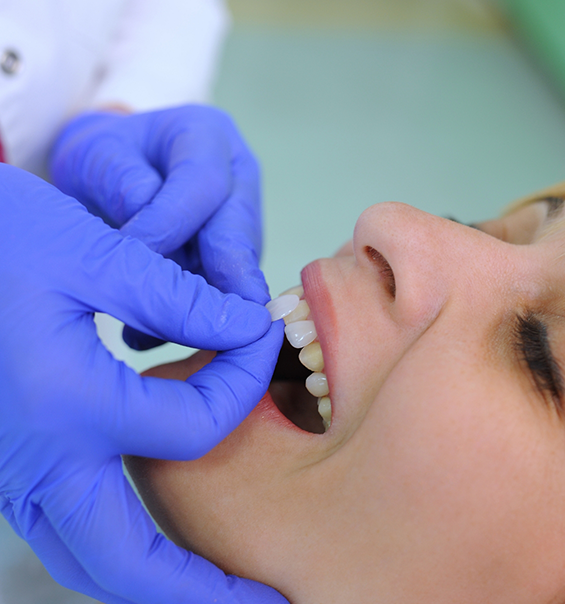 Dentist placing a veneer over a patients tooth