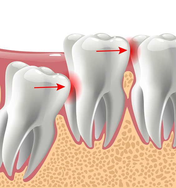 Illustration of an impacted wisdom tooth pressing against the adjacent teeth